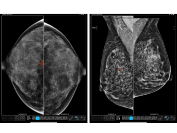 乳房X光篩檢AI整合性解決方案
