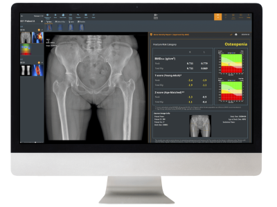 DeepXray : Osteoporosis AI-Assisted Diagnosis System