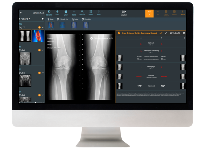 DeepXray : Osteoarthritis AI-Assisted Diagnosis System