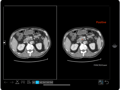PANCREASaver